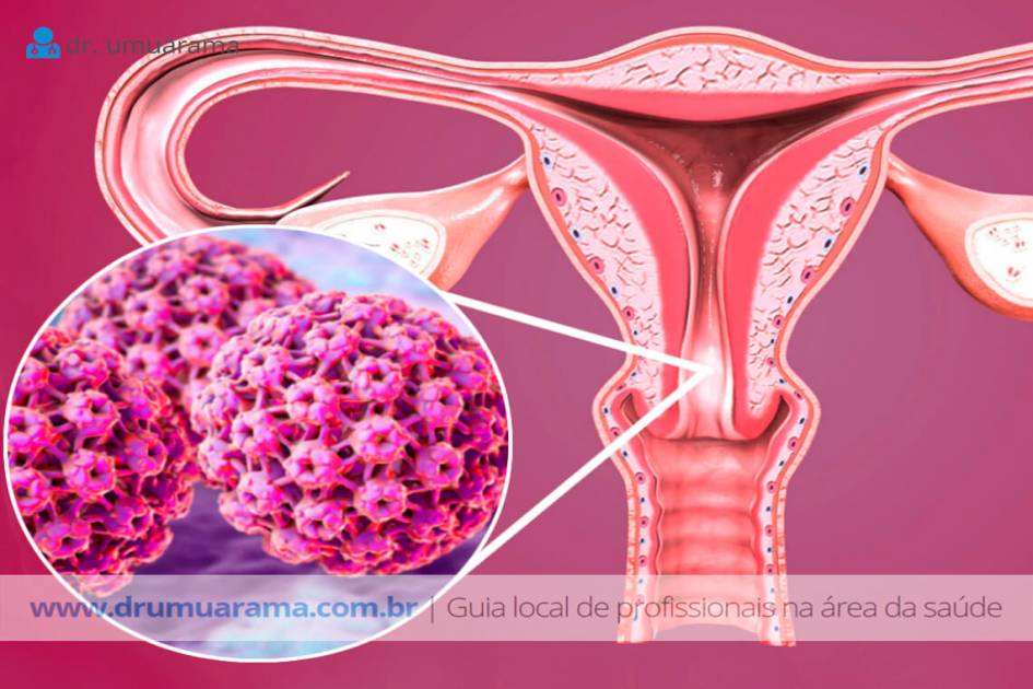 Dr Umuarama Materia Hpv